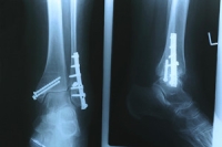 Reasons to Have Foot Surgery