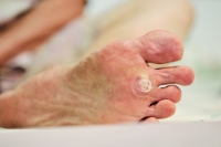 Should My Plantar Warts Feel Itchy?