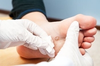 How Did I Get a Foot Wart?