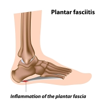 Seniors and Plantar Fasciitis